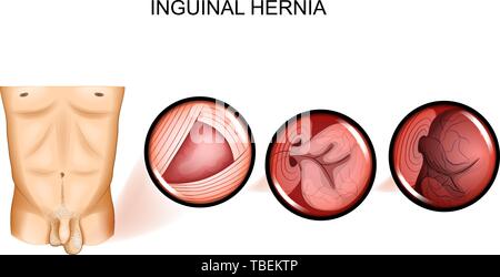 vector illustration of inguinal hernia entrapment. Surgery Stock Vector