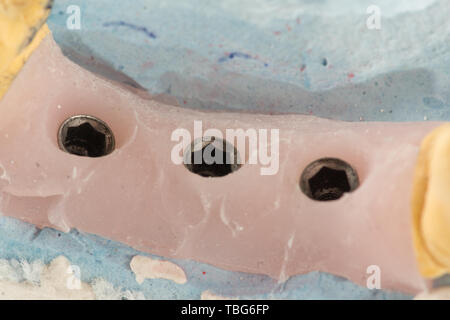 dental plaster model with artificial analogues of dental implants Stock Photo