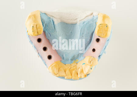 dental plaster model with artificial analogues of dental implants Stock Photo