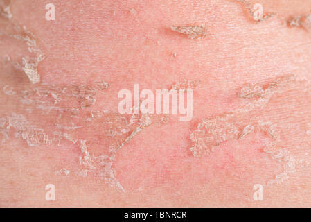 Sunburns of body, closeup. Skin damaged by sun, peeling. Body care theme Stock Photo