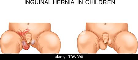 vector illustration of inguinal hernia of children Stock Vector