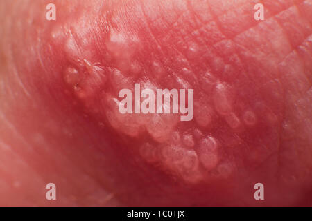 Beginning of growing herpes on caucasian male man on front upper lip super macro microscope Stock Photo
