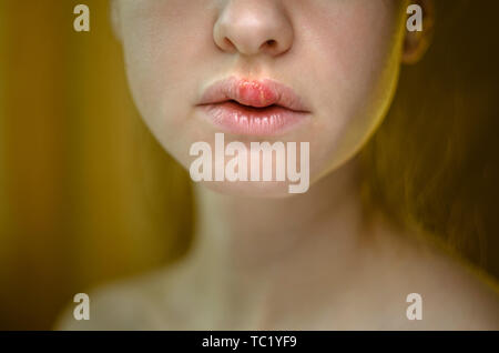 Herpes on the Upper Lip of a Young Woman. Medical Background of a Young Beautiful Girl with Herpes Labialis. Herpes Simplex Virus Stock Photo