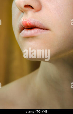 Herpes on the Upper Lip of a Young Woman. Medical Background of a Young Beautiful Girl with Herpes Labialis. Herpes Simplex Virus Stock Photo