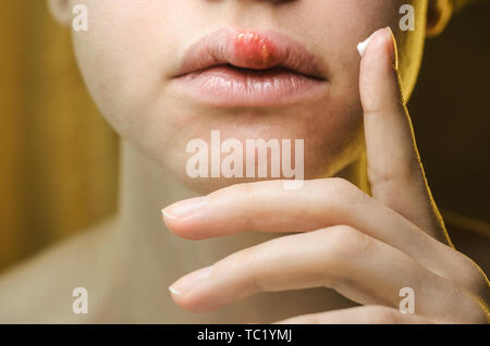 Woman Applying Ointment on Her Upper Lip with Herpes. Medical Background of a Young Beautiful Woman with Herpes Labialis. Treatment of Herpes Symptoms Stock Photo