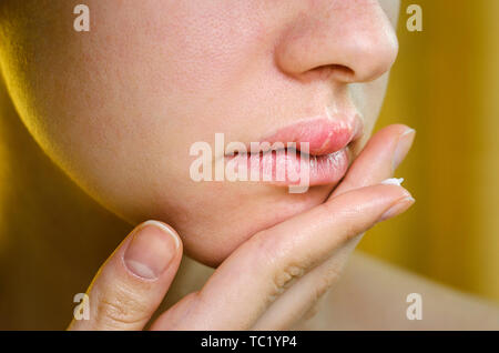 Woman Applying Ointment on Her Upper Lip with Herpes. Medical Background of a Young Beautiful Woman with Herpes Labialis. Treatment of Herpes Symptoms Stock Photo