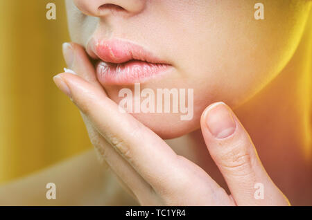 Woman Applying Ointment on Her Upper Lip with Herpes. Medical Background of a Young Beautiful Woman with Herpes Labialis. Treatment of Herpes Symptoms Stock Photo