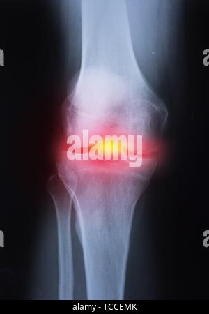 Medical x-ray knee joint image with arthritis ( Gout , Rheumatoid ...