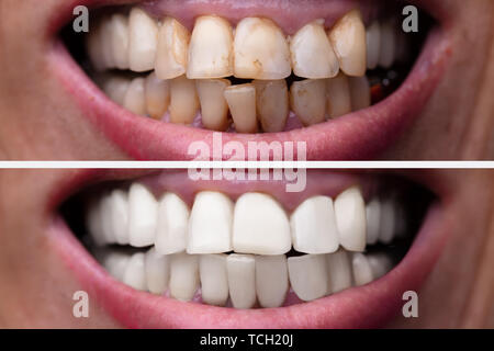 Female Teeth Between Before And After Dental Treatment Stock Photo