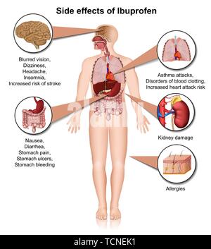 Side effects of ibuprofen 3d medical vector illustration on white background Stock Vector
