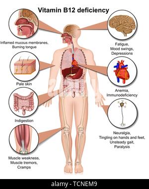 Vitamin B12 deficiency infographic, 3d medical vector illustration on white background Stock Vector