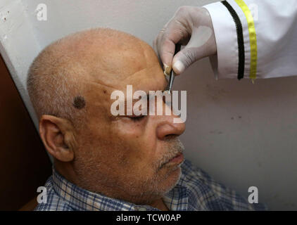 June 10, 2019 - Gaza City, Gaza Strip, Palestinian Territory - A Palestinian patient receives a bee-sting therapy by a health practitioner at a clinic in Gaza city on June 10, 2019. Apitherapy is the use of substances from honeybees, such as honey, propolis, royal jelly, or even venom (extracted or from live bees), to relieve various medical conditions. Most claims of apitherapy the medical use of bee venom are anecdotal and have not been proved to the satisfaction of scientists, although believers say it helps relieve pain from multiple sclerosis and rheumatoid arthritis and certain other ail Stock Photo
