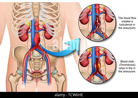 abdominal aneurysm description medical vector illustration on white background Stock Vector