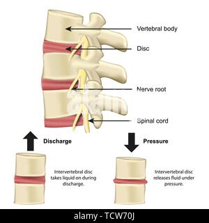 Vertebral body and disc anatomy and functionality on pressure medical vector illustration eps 10 Stock Vector