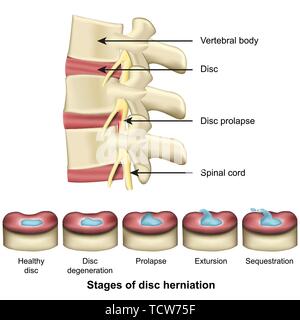 Stages of disc herniation spine and disc anatomy 3d medical vector illustration eps 10 Stock Vector