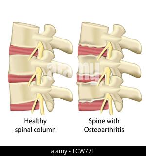 Spine with osteoarthritis ,spinal column medical vector illustration isolated on white background eps 10 Stock Vector