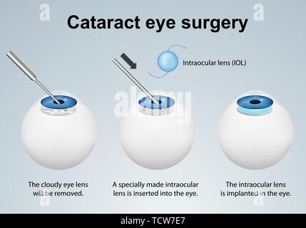 Cataract eye surgery process medical vector illustration isolated on grey background eps 10 infographic Stock Vector