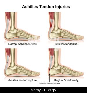 Achilles tendon injures medical vector illustration isolated on white background with english description eps 10 infographic Stock Vector