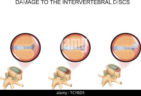 vector illustration of intervertebral disc damage. vertebra Stock Vector