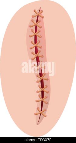 Skin scar with seam cartoon illustration. Bloody wound, injures ...