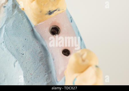 dental plaster model with artificial analogues of dental implants Stock Photo