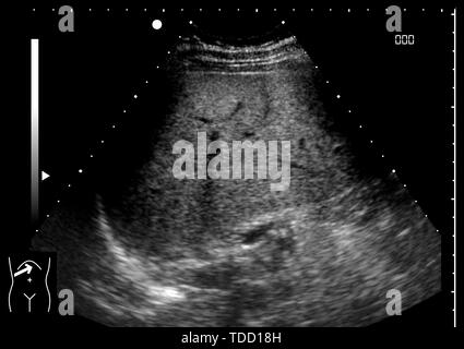 Healthy liver, ultrasound scan Stock Photo