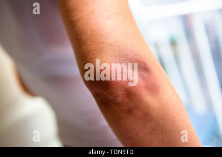 contusion Stock Photo