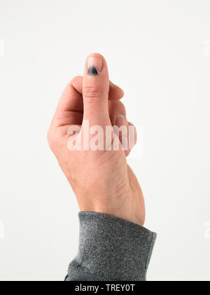 Thumb injury. Black nail after being hit with a hammer Stock Photo