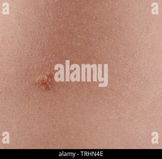 One mole spot on human skin close up view Stock Photo