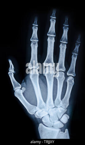 X-ray image of the hand on black background. Stock Photo
