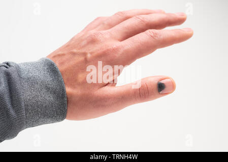 Blackened nail after being hit with a hammer. Thumb injury Stock Photo
