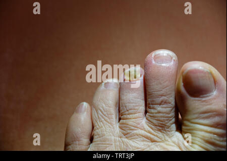 Ripped toenail hi-res stock photography and images - Alamy