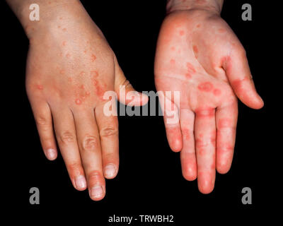 Child with red rash from Coxsackievirus, on both hands, palm, and backside, isolated on black Stock Photo
