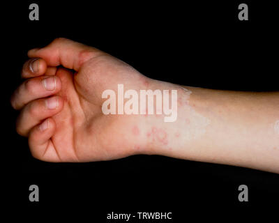 Child with red rash from Coxsackievirus, on right hand palm and wrist, isolated on black Stock Photo