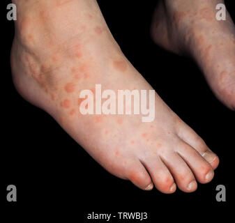 Child with red rash from Coxsackievirus, on both feet, isolated on black Stock Photo