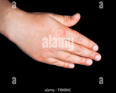Child with red rash from Coxsackievirus, on right hand, isolated on black Stock Photo