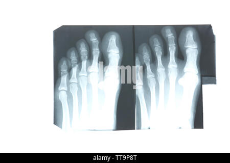 X-ray of feet isolated on white Stock Photo