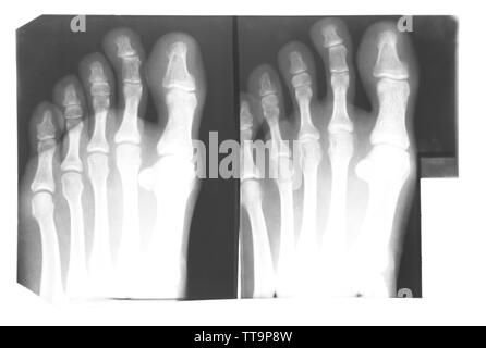 X-ray of feet isolated on white Stock Photo