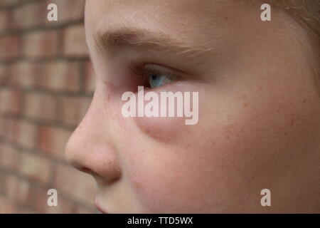 Profile picture of a young boy with swelling of face due to hornet sting Stock Photo