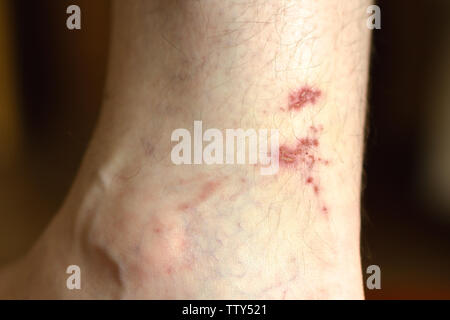 scratch on man's leg. wound on the skin Stock Photo - Alamy