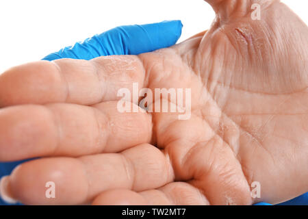 Doctor examining patient with dermatitis on hand, closeup Stock Photo