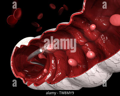 3d illustration of Removal of a colonic polyp with a electrical wire loop during a colonoscopy Stock Photo