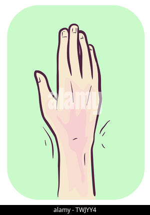 Illustration of a Hand Showing Redness and Pain in Wrist Stock Photo