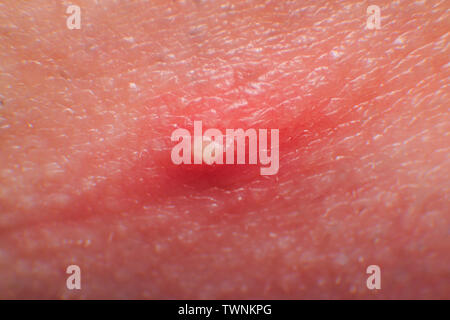 Anatomy Of Skin And Hair Follicle On White Background Stock Photo