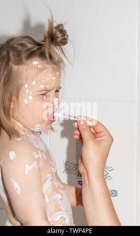 Varicella virus or Chickenpox bubble rash on child, baby or adoult. Stock Photo