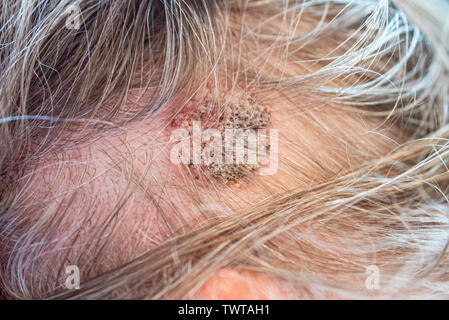 seborrheic keratosis scalp