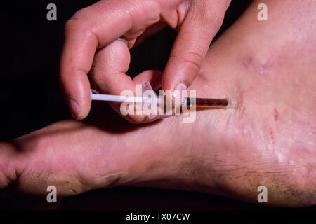 A person using a hypodermic needle to inject themselves in the foot with black tar heroin.