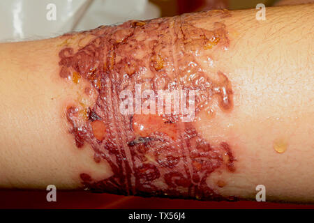 Réaction allergique importante après un tatouage au henné Stock Photo