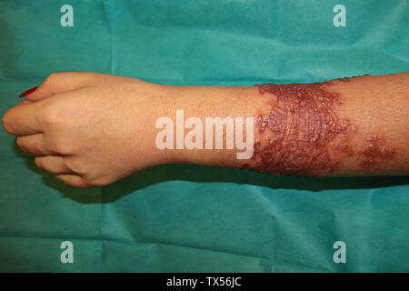 Réaction allergique importante après un tatouage au henné Stock Photo