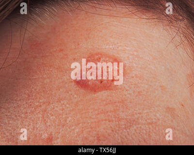 Carcinome baso cellulaire du front Stock Photo - Alamy